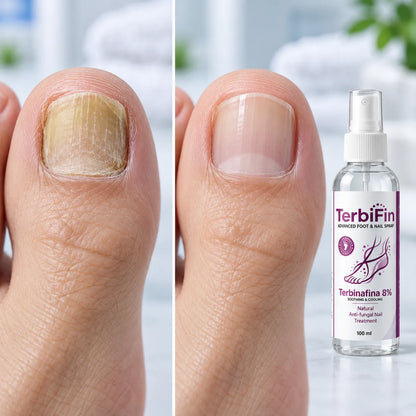 TerbiFin Spray 8% Anti-Hongos Pies Uñas